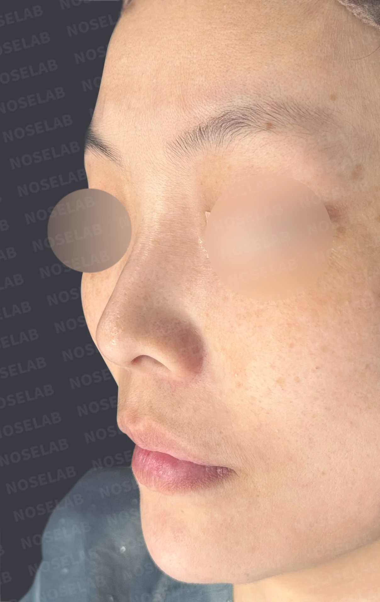 첫 코성형에서 코끝 구조와 콧구멍 노출은 어떻게 다루나 — 수술 전 / 수술 직후 0일 직후 사진은 부기가 있는 상태로 최종 결과와 다를 수 있습니다.