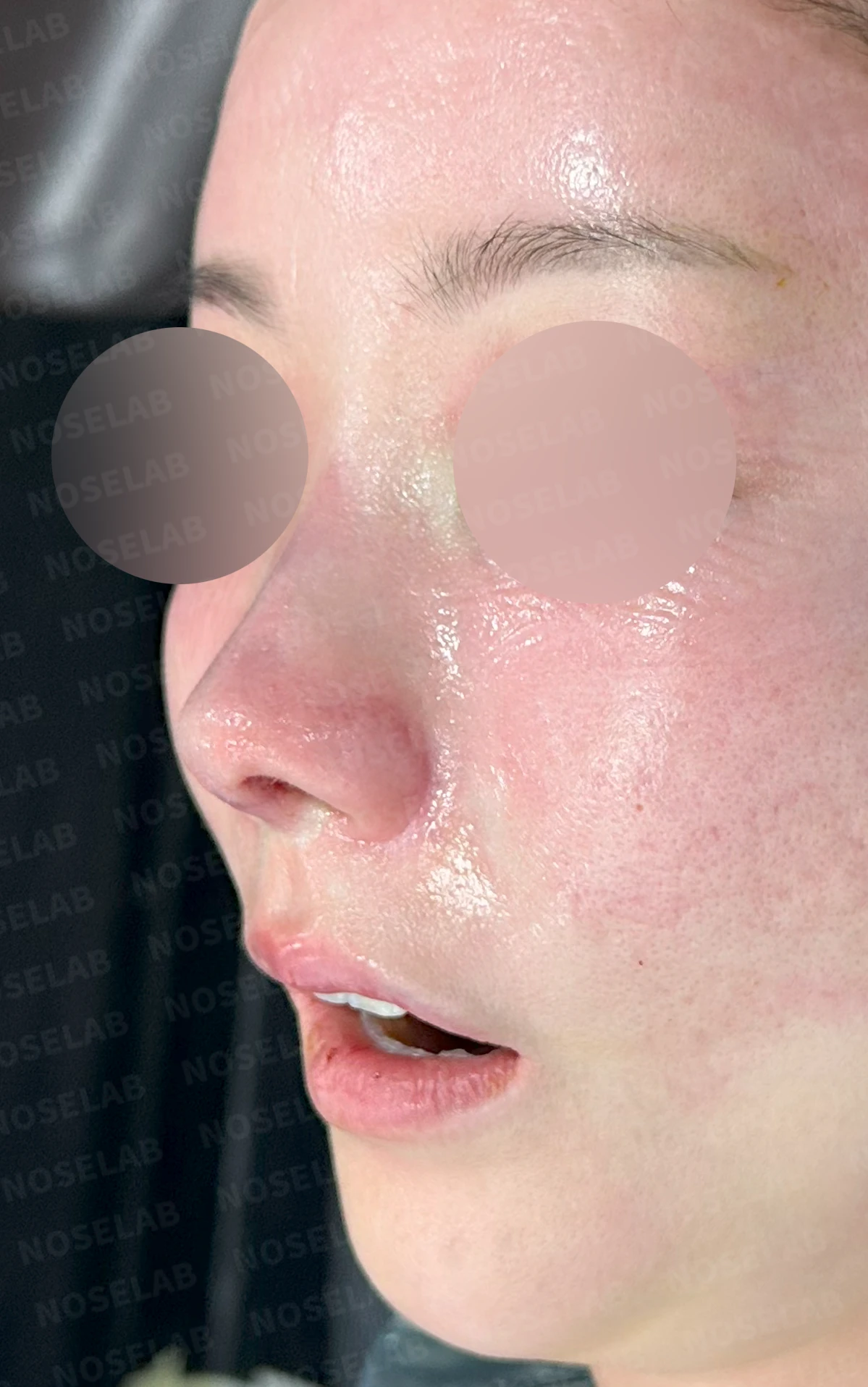 코성형 후 남는 미세한 높이 부족과 좌우 비대칭, 왜 생기고 어떻게 보강하나 — 수술 직후 0일 정면 , 측면 , 비스듬한 측면 사진입니다. 직후 사진은 부기가 있는 상태로 최종 결과와 다를 수 있습니다.