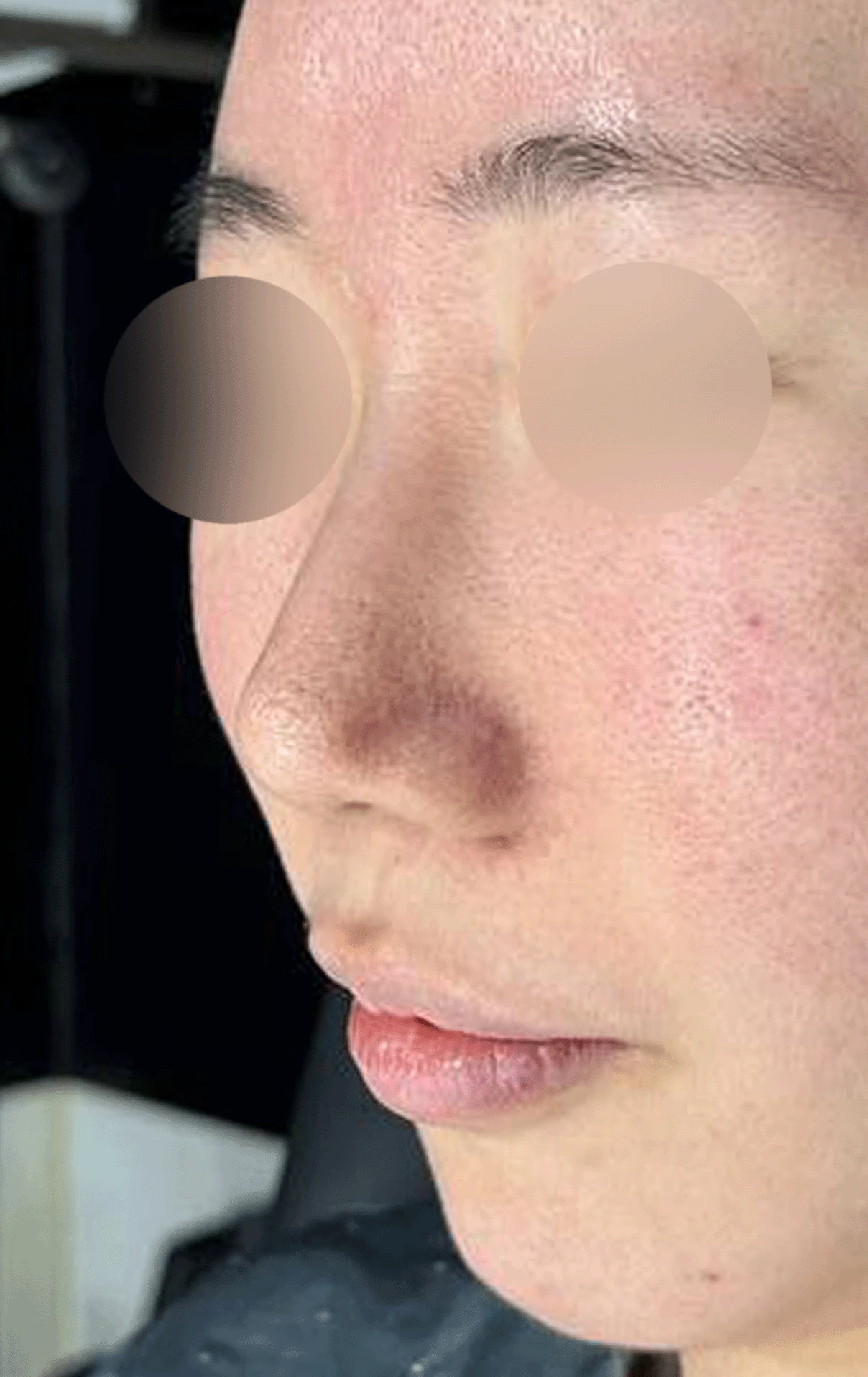 오래된 코 수술 뒤 비주가 함몰되고 코끝이 뭉툭해지는 이유와 재건 방법 — 본문 사진 11