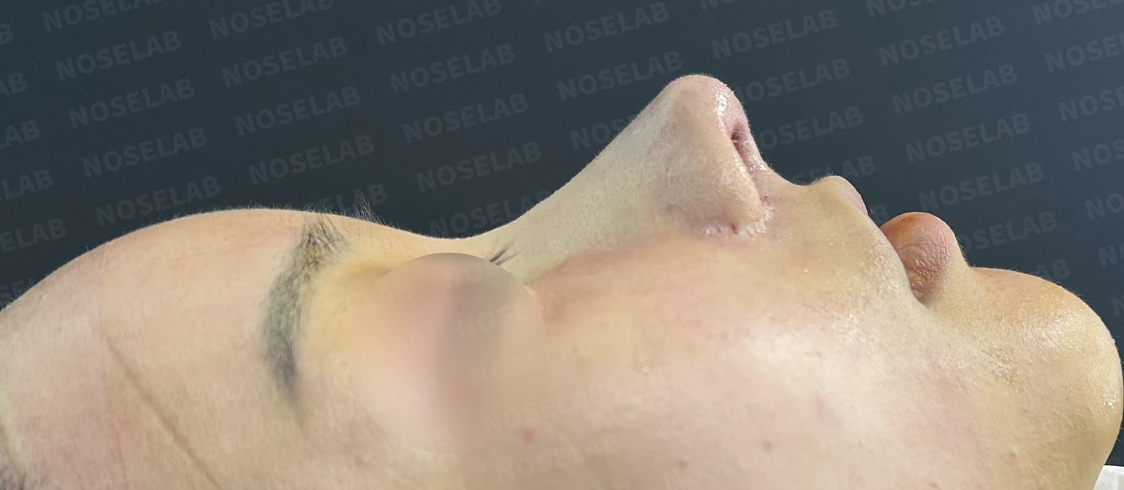 비공 비대칭, 퍼진코! 코재수술 사례 — 전(좌) 직후(우)