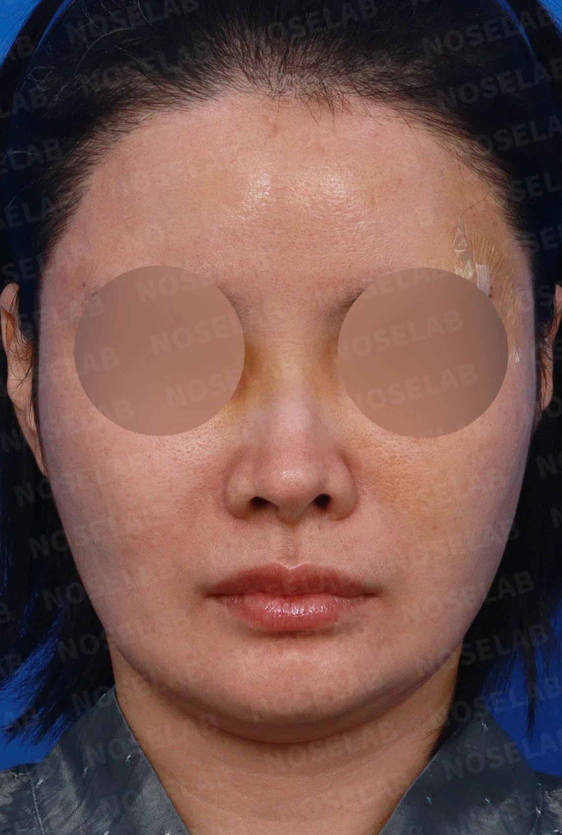 외상으로 코뼈가 부러지면 코가 어떻게 변형되고, 정복과 재건은 어떻게 하나 — 디자인 상담 정면, 좌측 측면, 비스듬한 측면 사진입니다.