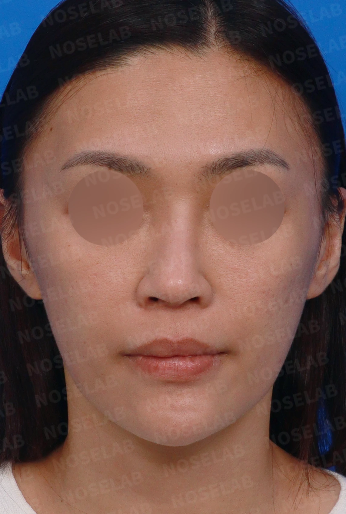 오래된 보형물 코의 코끝 지지력이 약해지는 이유와 비중격연장 재건 방법 — 디자인 상담 정면, 좌측 측면, 비스듬한 측면 사진입니다.