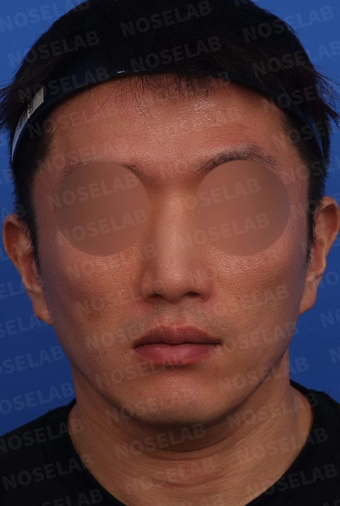 매부리코·휜코 교정 방법 — 수술전 정면, 비스듬한 측면 사진입니다.