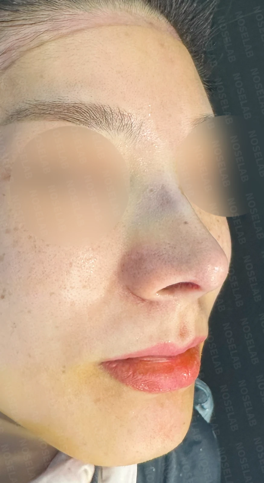 복코, 퍼진코 교정 방법 — 수술 직후 0일 정면, 측면, 비스듬한 측면 사진 직후 사진은 부기가 있는 상태로 최종 결과와 다를 수 있습니다.
