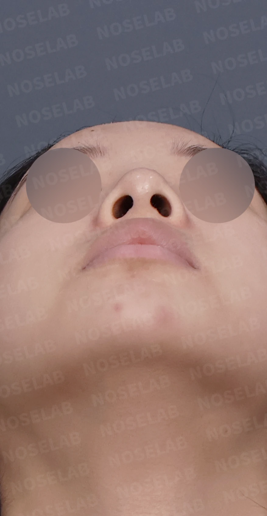 콧대가 넓고 단차져 보이는 이유, 절골술과 늑연골 코끝 성형은 어떻게 하나 — 디자인 상담 우측 측면, 비스듬한 측면, 비공 사진입니다.