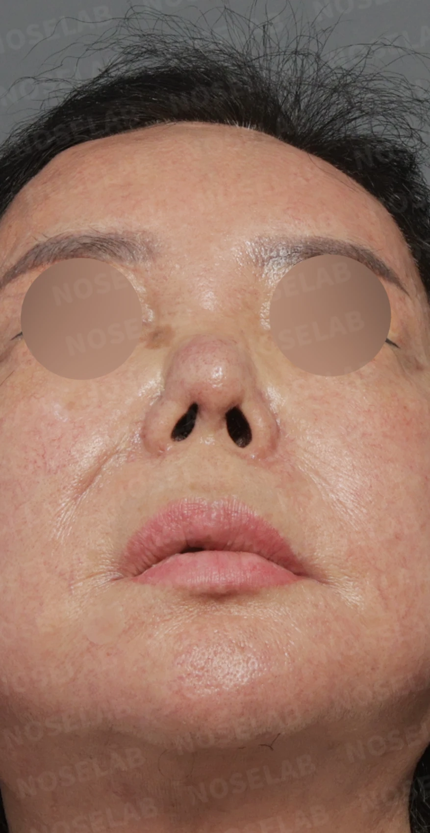 보형물 염증으로 손상된 코, 휴식기 후 기증늑연골로 안전하게 재건한 코재수술 — 디자인 상담 우측 측면, 비스듬한 측면, 비공 사진입니다.