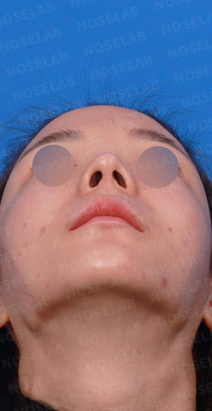 비주가 길어 보이는 이유와 코끝 연골 재배치 방법 — 디자인 상담 정면, 좌측 측면, 비스듬한 측면 사진입니다.