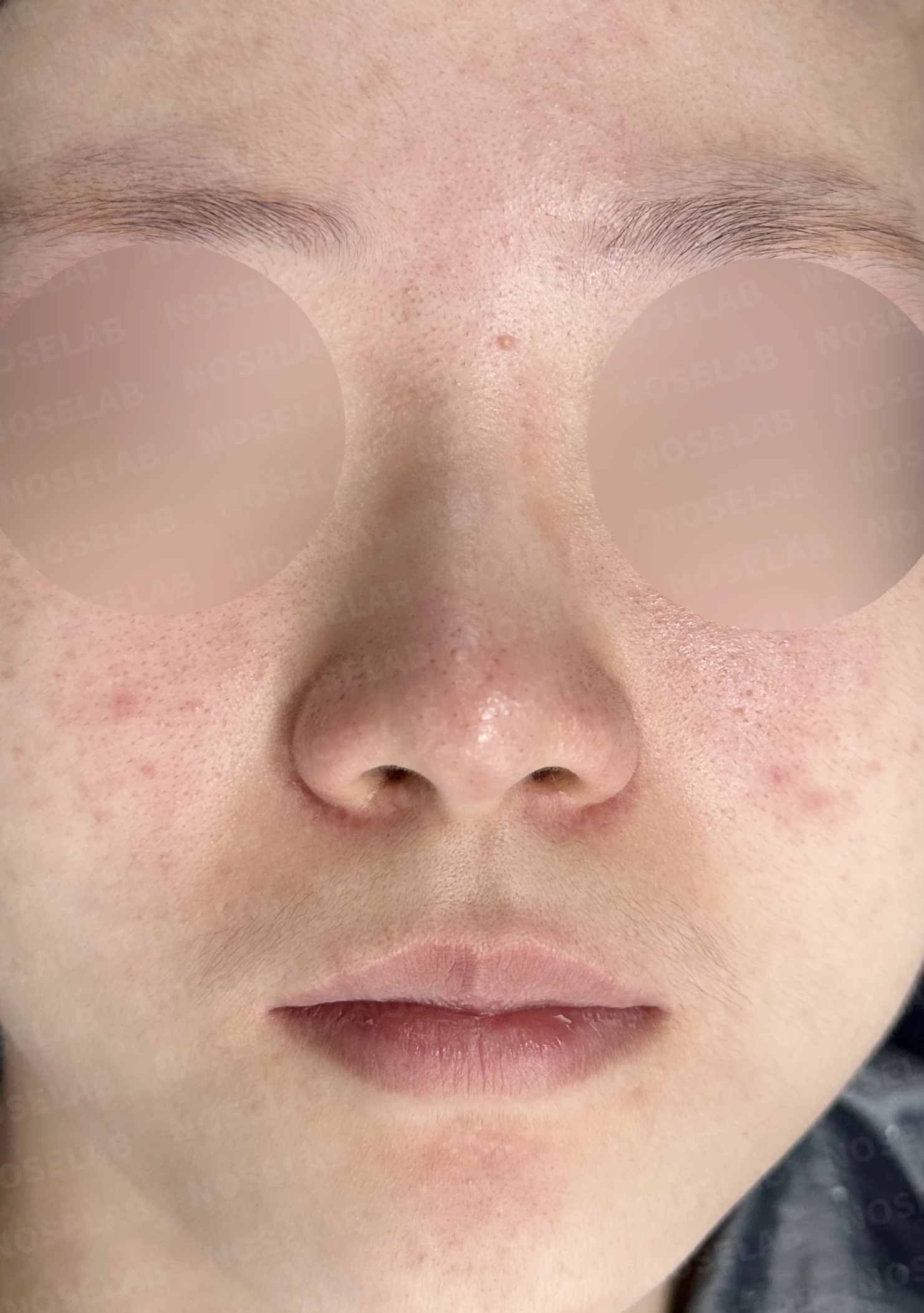 콧대가 퍼져 보이고 코끝이 뭉툭한 이유, 절골술과 자가 늑연골 교정은 어떻게 하나 — 수술 전 / 수술 직후 0일 직후 사진은 부기가 있는 상태로 최종 결과와 다를 수 있습니다.