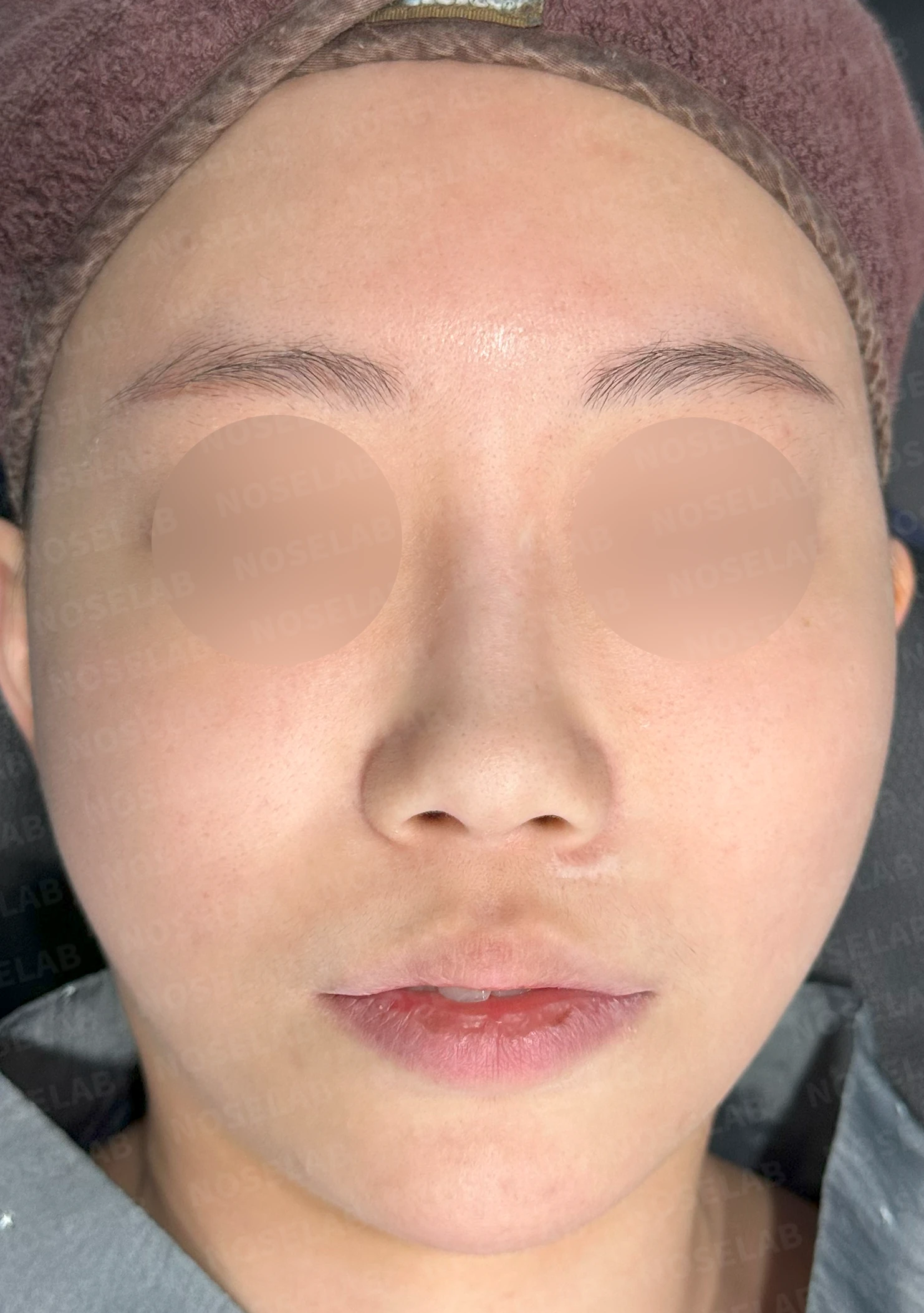 필러와 실이 남아 있는 코, 제거 후 늑연골 재건은 어디까지 가능한가 — 수술 전 / 수술 직후 0일 직후 사진은 부기가 있는 상태로 최종 결과와 다를 수 있습니다.