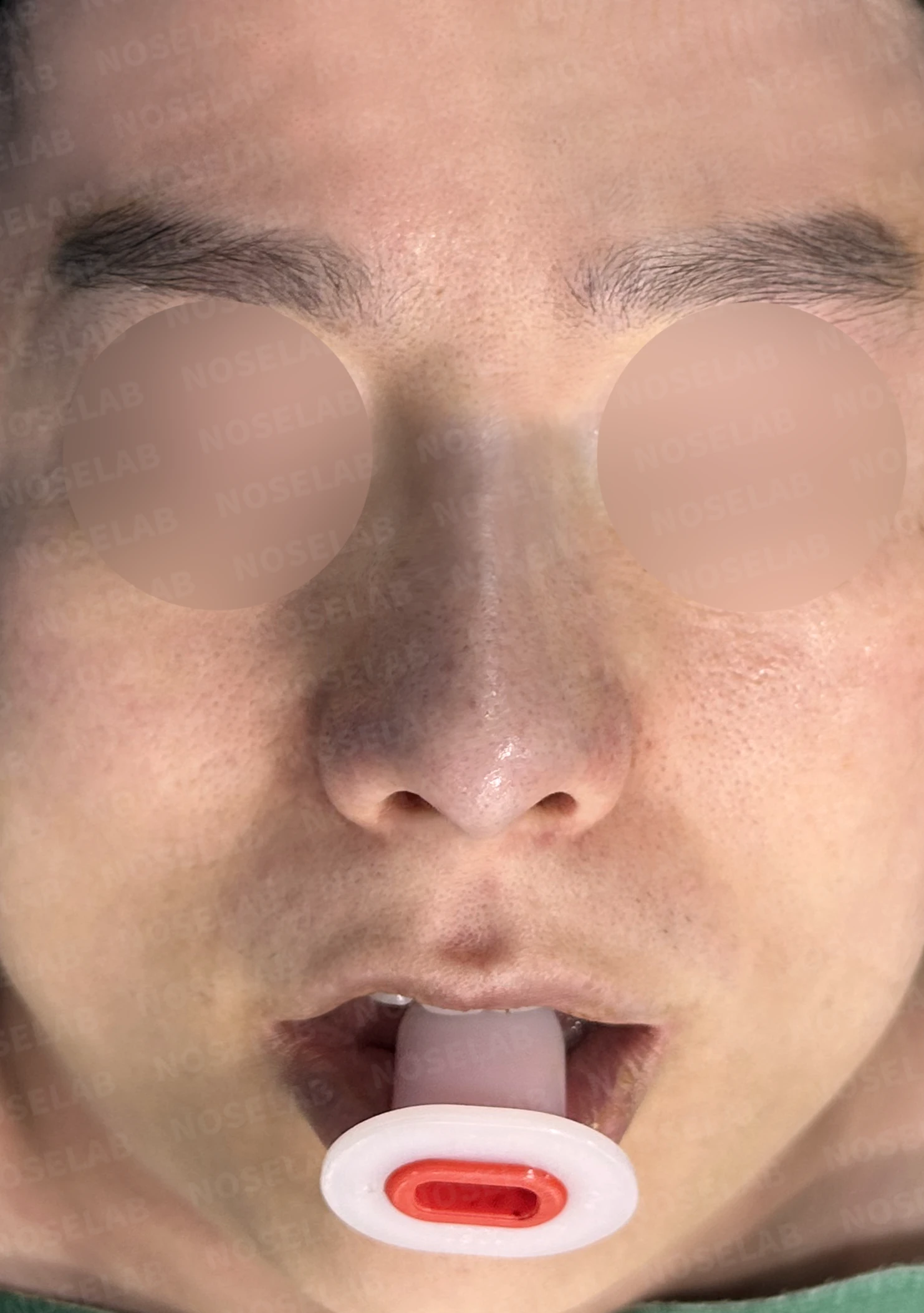 휘어진 매부리코, 자가늑연골로 교정한 남자 코성형 사례 — 수술직후 정면, 비스듬한 측면, 측면 사진입니다.