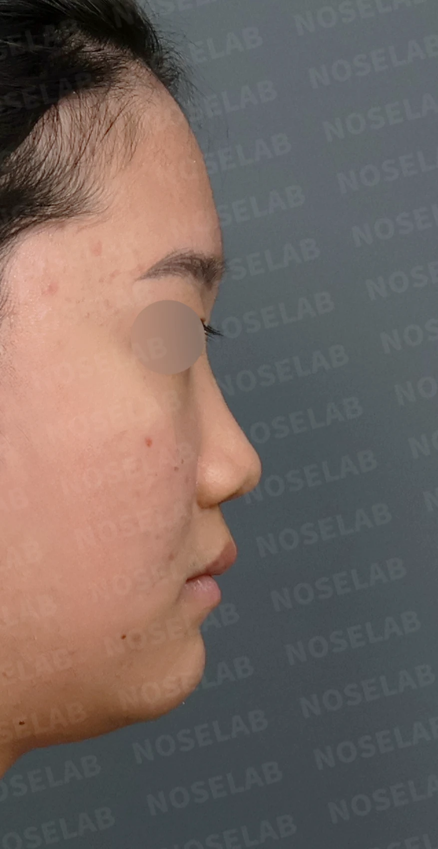 콧대가 낮고 코끝이 뭉툭해 보이는 이유, 함몰된 비주와 함께 교정하는 방법 — 디자인 상담 우측 측면, 비스듬한 측면, 비공 사진입니다.