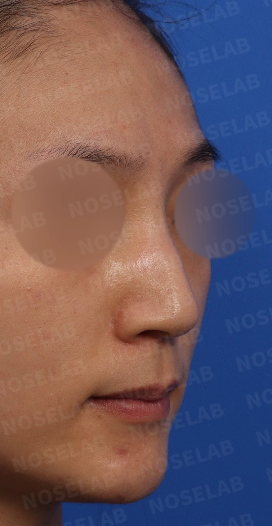 뭉툭한 처진코 교정 방법 — 본문 사진 3