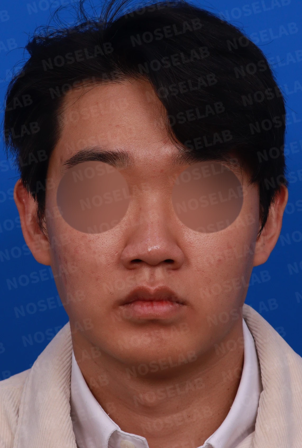 낮은 코와 코막힘을 함께 살펴보는 교정 방법 — 디자인 상담 정면, 좌측 측면, 비스듬한 측면 사진
