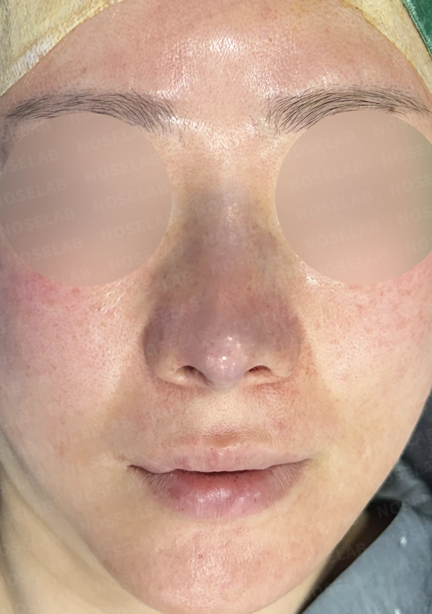 길고 처진 코 교정, 자가늑연골 비중격 재건과 콧대 보형물 교체로 완성한 코재수술 — 전(좌) 직후(우)