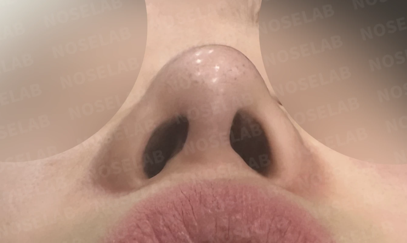 화살코와 복코가 함께 있는 코, 비중격 재건부터 시작하는 이유 — 수술 전 / 수술 직후 0일 직후 사진은 부기가 있는 상태로 최종 결과와 다를 수 있습니다.