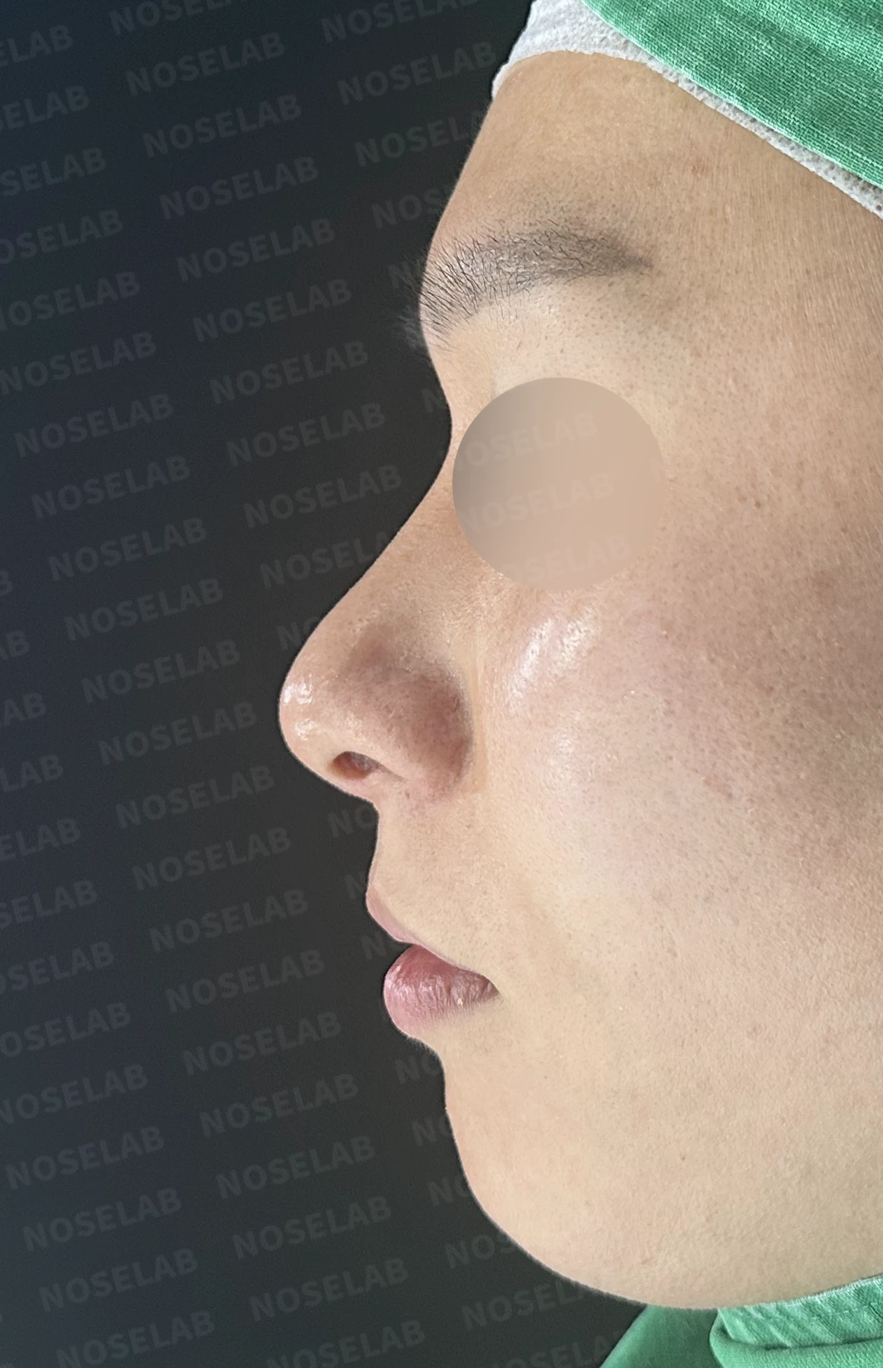 한쪽 비골이 함몰되면 왜 코가 휘어 보이는가, 절골 복원과 비중격 재건 — 수술 전 / 수술 직후 0일 직후 사진은 부기가 있는 상태로 최종 결과와 다를 수 있습니다.