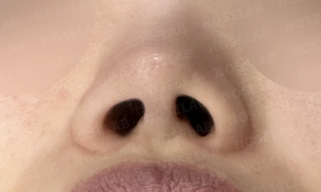 짧고 들린 코와 휜 코가 함께 생기는 이유, 비중격 연장 교정은 어떻게 하나 — 수술 전 / 수술 직후 0일 직후 사진은 부기가 있는 상태로 최종 결과와 다를 수 있습니다.