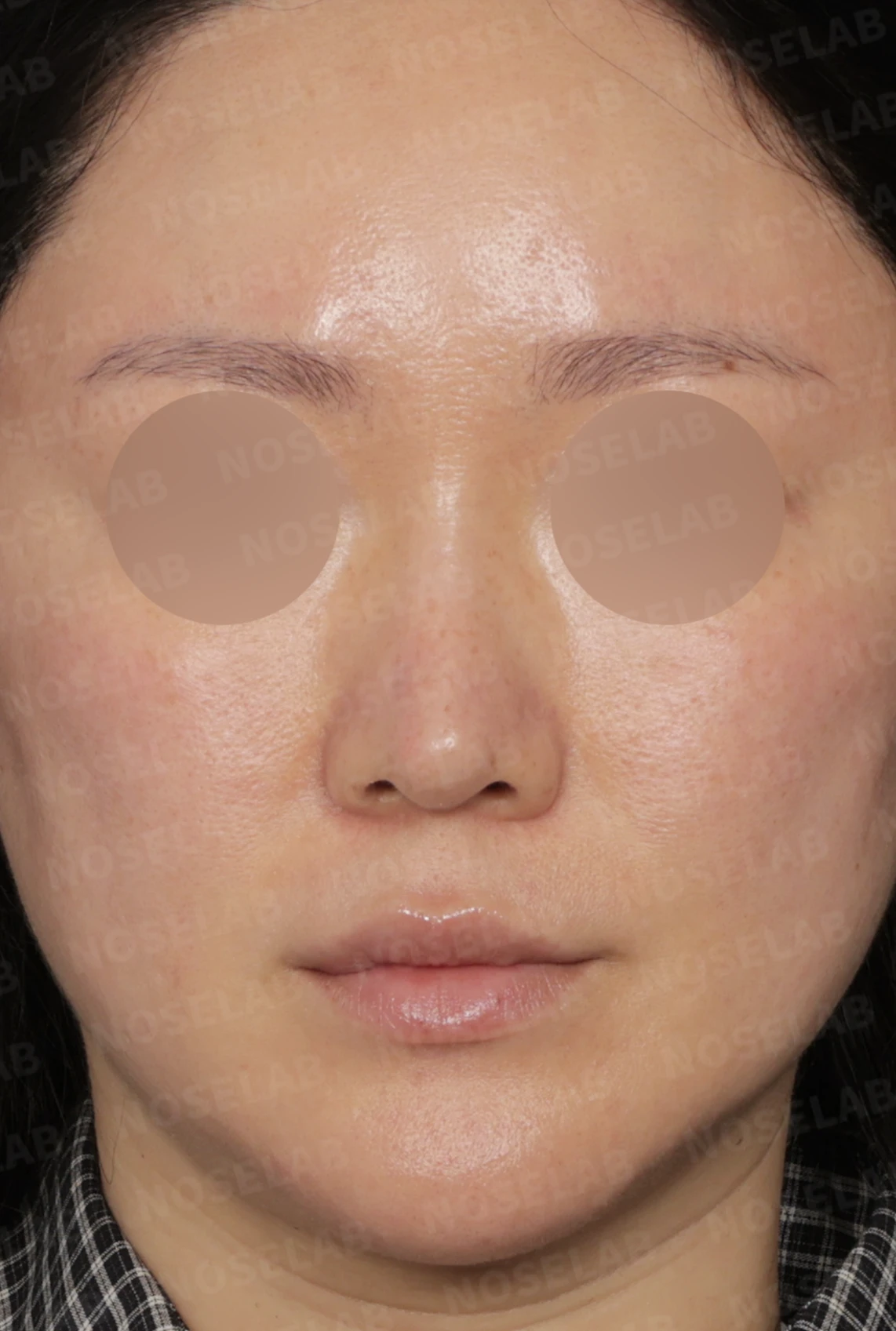 길고 처진 코 교정, 자가늑연골 비중격 재건과 콧대 보형물 교체로 완성한 코재수술 — 디자인 상담 정면 , 좌측 측면 , 비스듬한 측면 사진 입니다.
