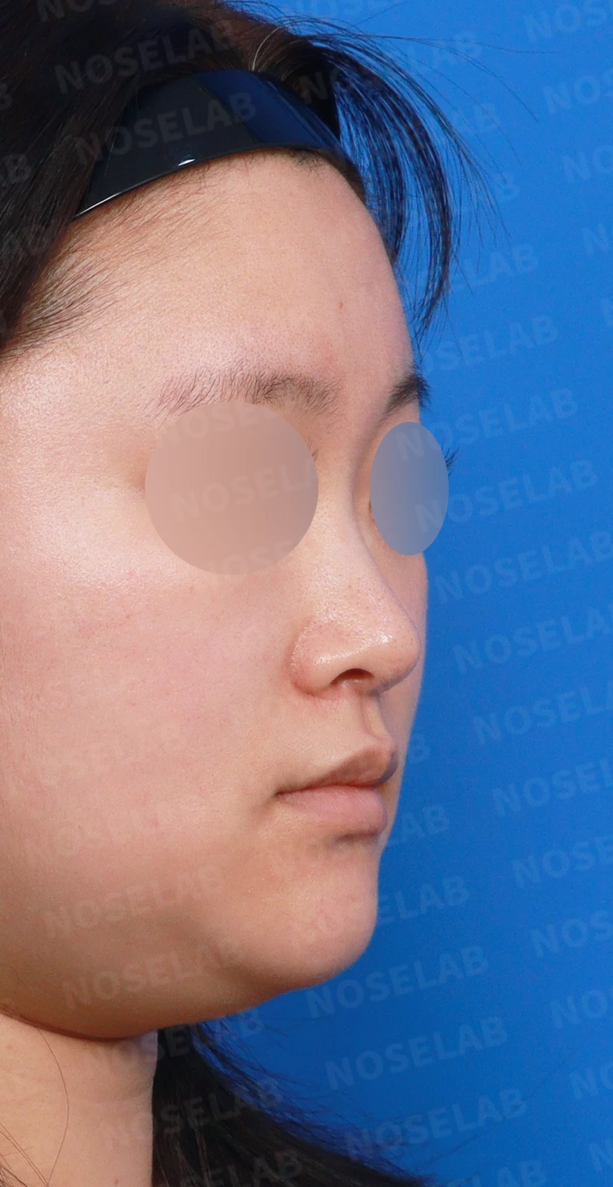 코가 퍼지고 코끝이 뭉툭해 보이는 이유, 비중격연골과 귀연골 교정은 어떻게 하나 — 디자인 상담 우측 측면, 비스듬한 측면, 비공 사진입니다.