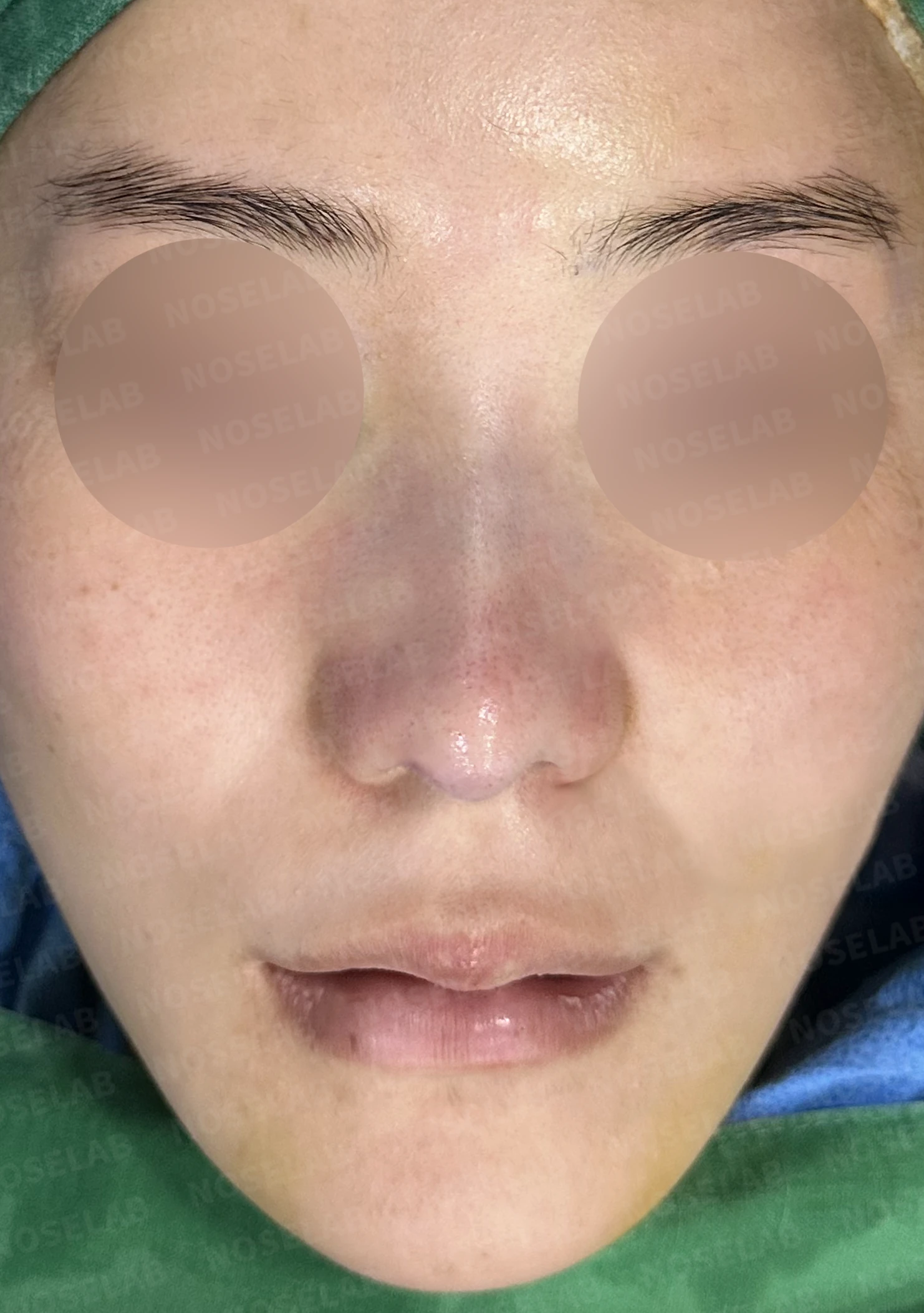 들린 코와 한쪽만 찝힌 콧구멍이 생기는 이유, 무보형물 재건은 어떻게 하나 — 수술 전 / 수술 직후 0일 직후 사진은 부기가 있는 상태로 최종 결과와 다를 수 있습니다.