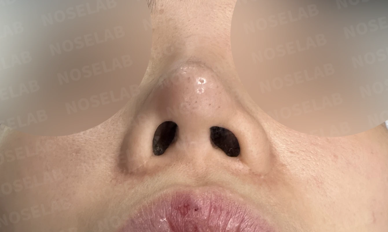 휘어진 코와 퍼진 코끝, 자가늑연골로 세련된 직반라인 완성한 코재수술 — 전(좌) 직후(후)