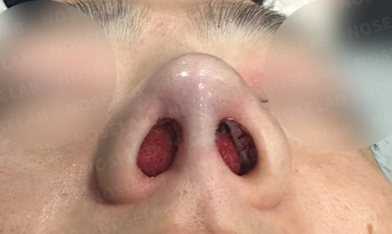 콧구멍 비대칭과 들린 코가 함께 생기는 이유, 늑연골 재건은 어떻게 하나 — 수술 직후 0일 비공 사진 직후 사진은 부기가 있는 상태로 최종 결과와 다를 수 있습니다.
