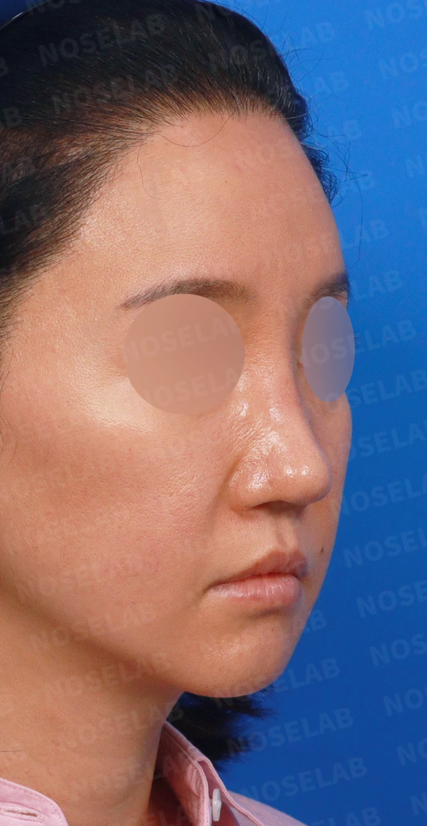 여러 번의 코재수술 뒤 비중격이 무너지는 이유, 자가늑연골 전면 재건은 어떻게 하나 — 디자인 상담 우측 측면, 비스듬한 측면, 비공 사진입니다.