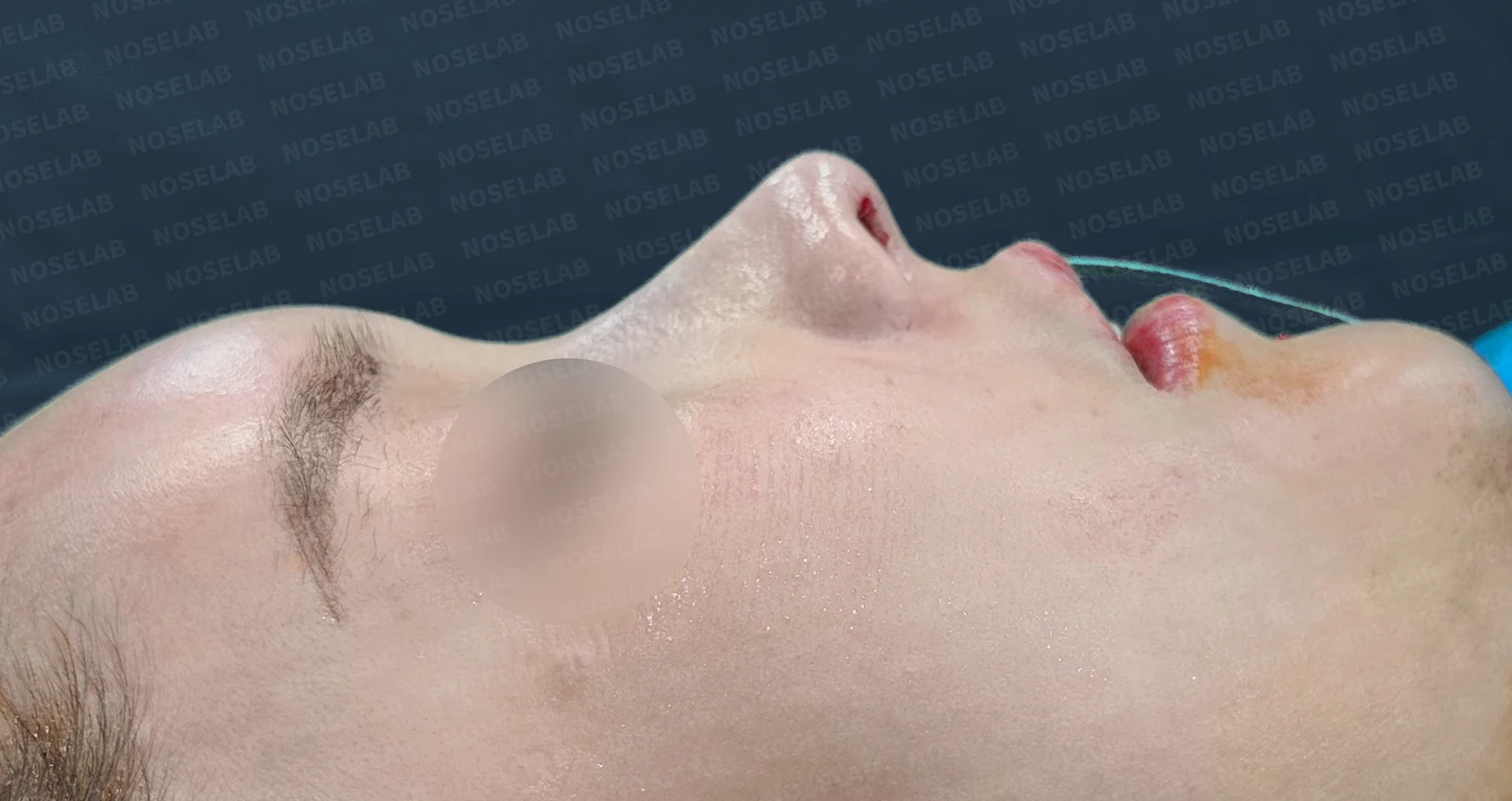 돌출입과 비순각을 함께 살펴보는 코성형 계획 — 수술 전 / 수술 직후 0일 직후 사진은 부기가 있는 상태로 최종 결과와 다를 수 있습니다.