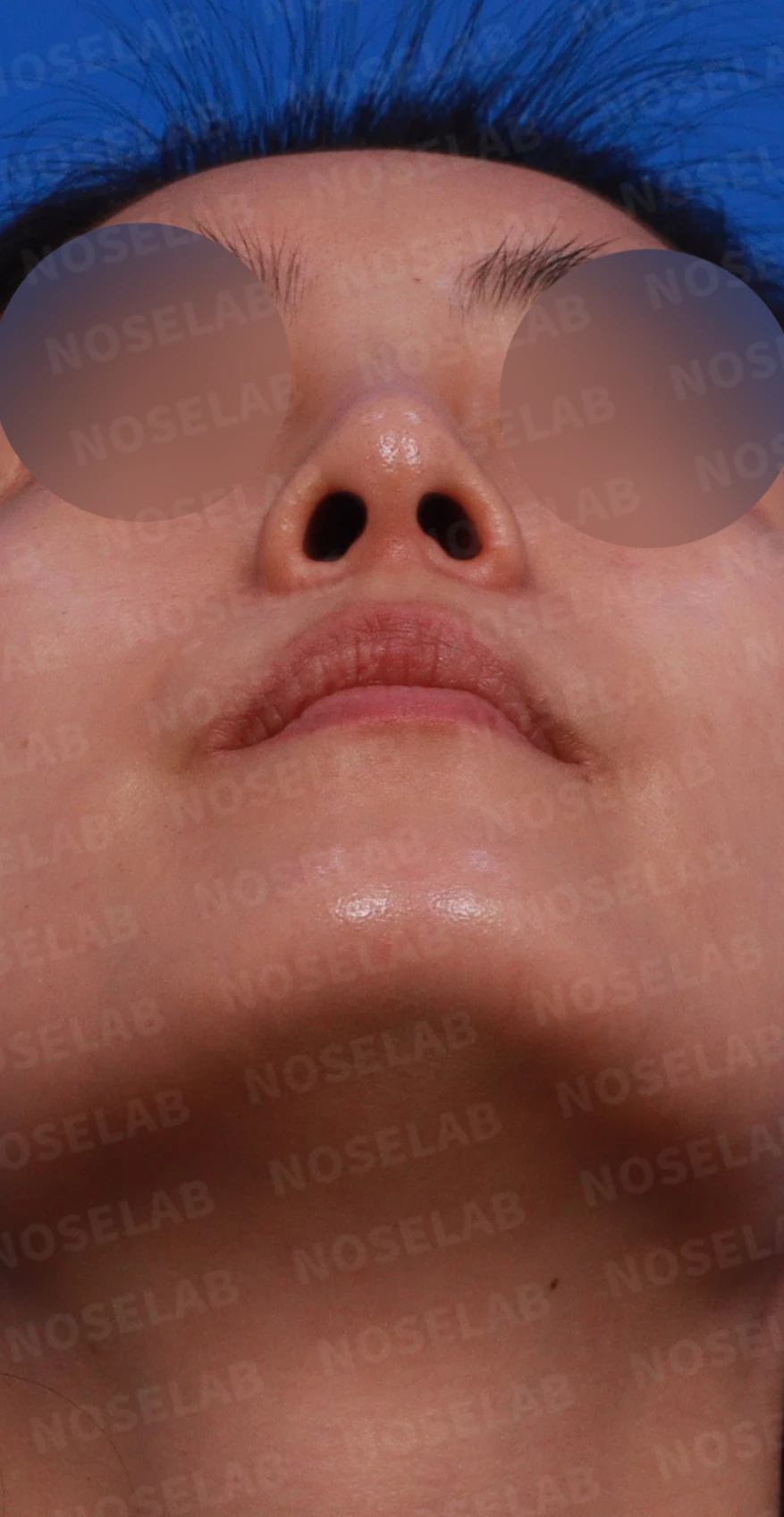 여러 차례 받은 코필러가 남긴 퍼진 코와 코막힘, 어떻게 정리하나 — 디자인 상담 우측 측면, 비스듬한 측면, 비공 사진