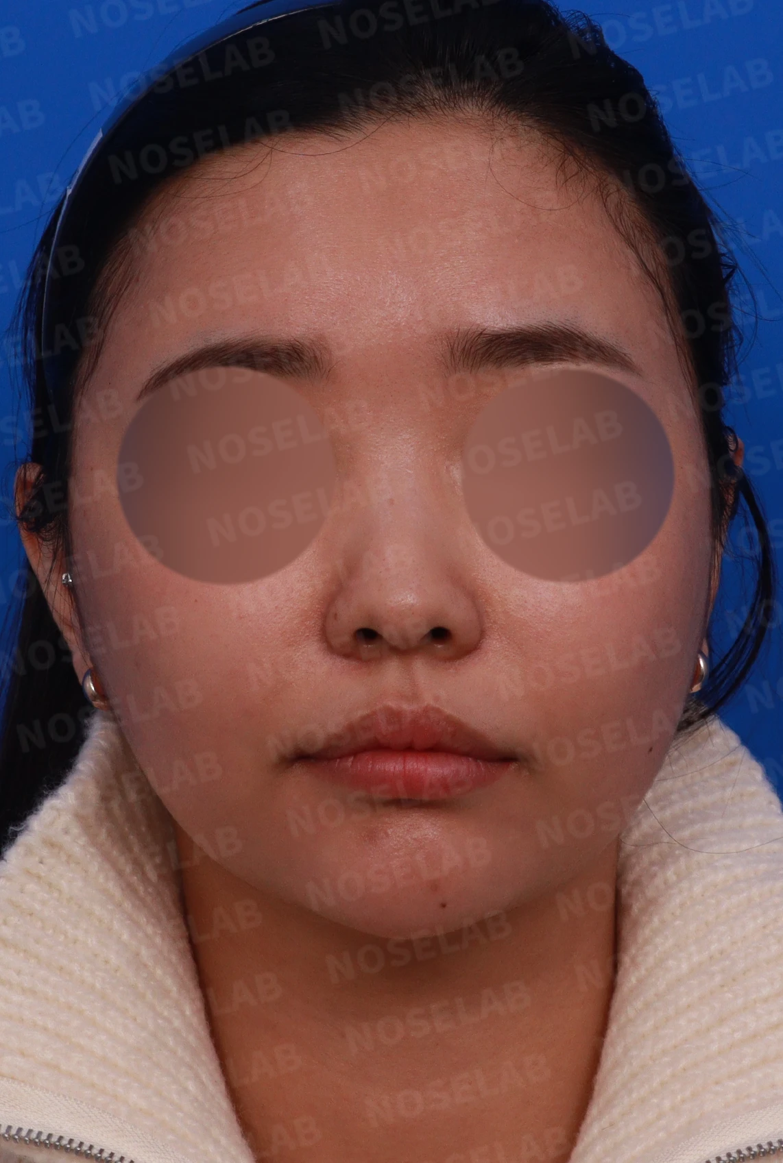 비염 수술을 받았는데도 코막힘이 돌아오는 이유, 구조 교정은 어떻게 하나 — 디자인 상담 정면, 좌측 측면, 비스듬한 측면 사진