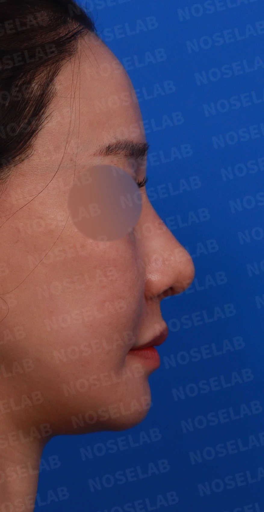 복코와 휜코의 구조를 살펴보는 교정 방법 — 디자인 상담 우측 비스듬한 측면, 측면, 비공 사진입니다.