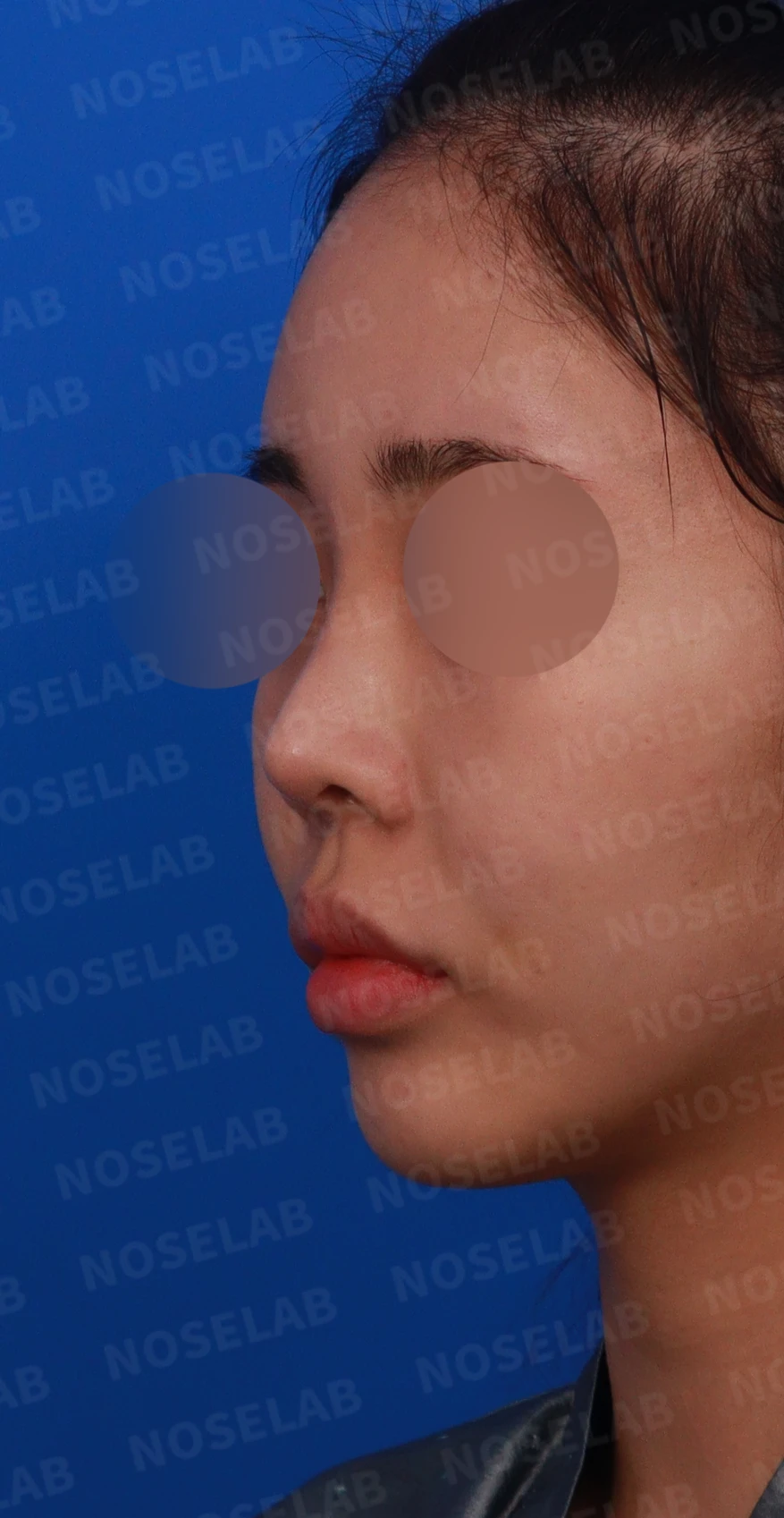 적절하지 않은 L자 실리콘 개선 - 안전한 구조로 재건 후기 — 디자인 상담 정면, 좌측 측면, 비스듬한 측면 사진