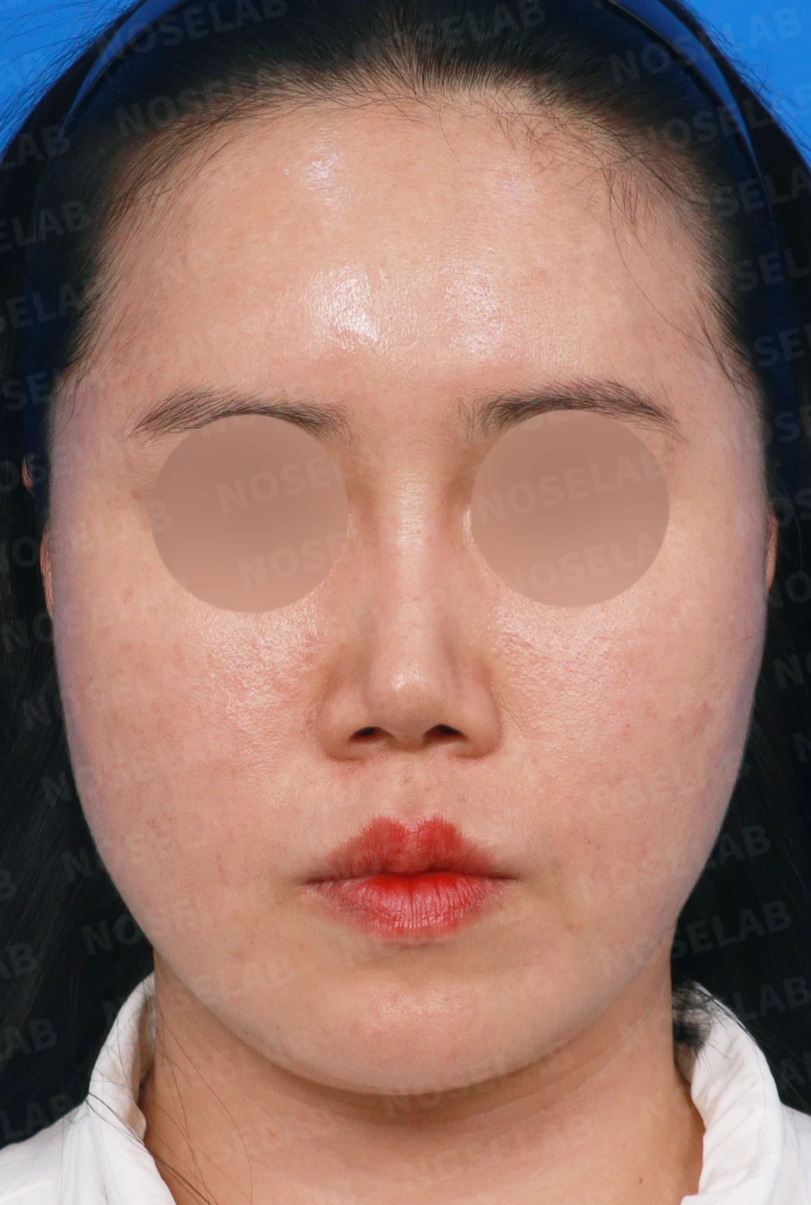 메드포어를 넣은 코에 코막힘이 생기는 이유, 제거와 자가늑연골 비중격 재건은 어떻게 하나 — 디자인 상담 정면, 좌측 측면, 비스듬한 측면 사진입니다.