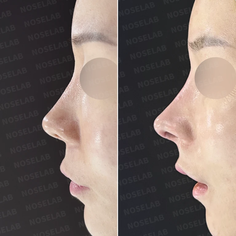 휘어진 코와 길어 보이는 비주, 자가늑연골로 자연스럽게 교정하다 — 전후 비교