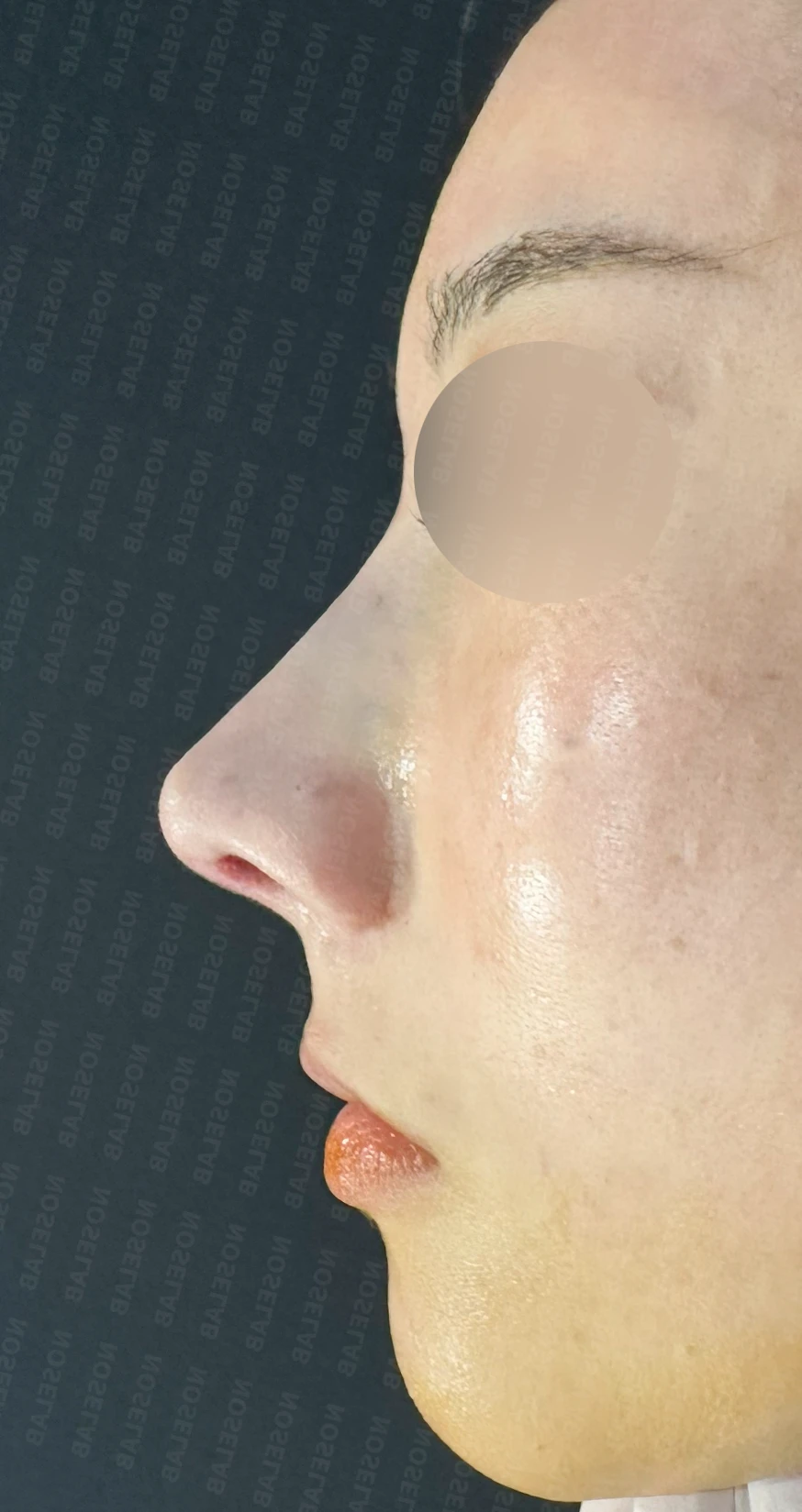 코뼈 비대칭과 처진 코끝에 만성 비염이 겹칠 때 보는 것 — 수술 전 / 수술 직후 0일 직후 사진은 부기가 있는 상태로 최종 결과와 다를 수 있습니다.