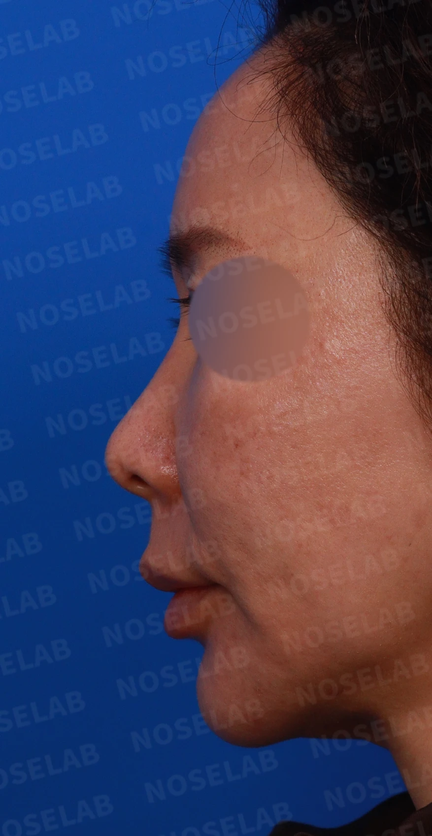 인중 길이와 콧날개 비대칭을 고려한 코 교정 방법 — 디자인 상담 정면, 좌측 측면, 비스듬한 측면 사진입니다.