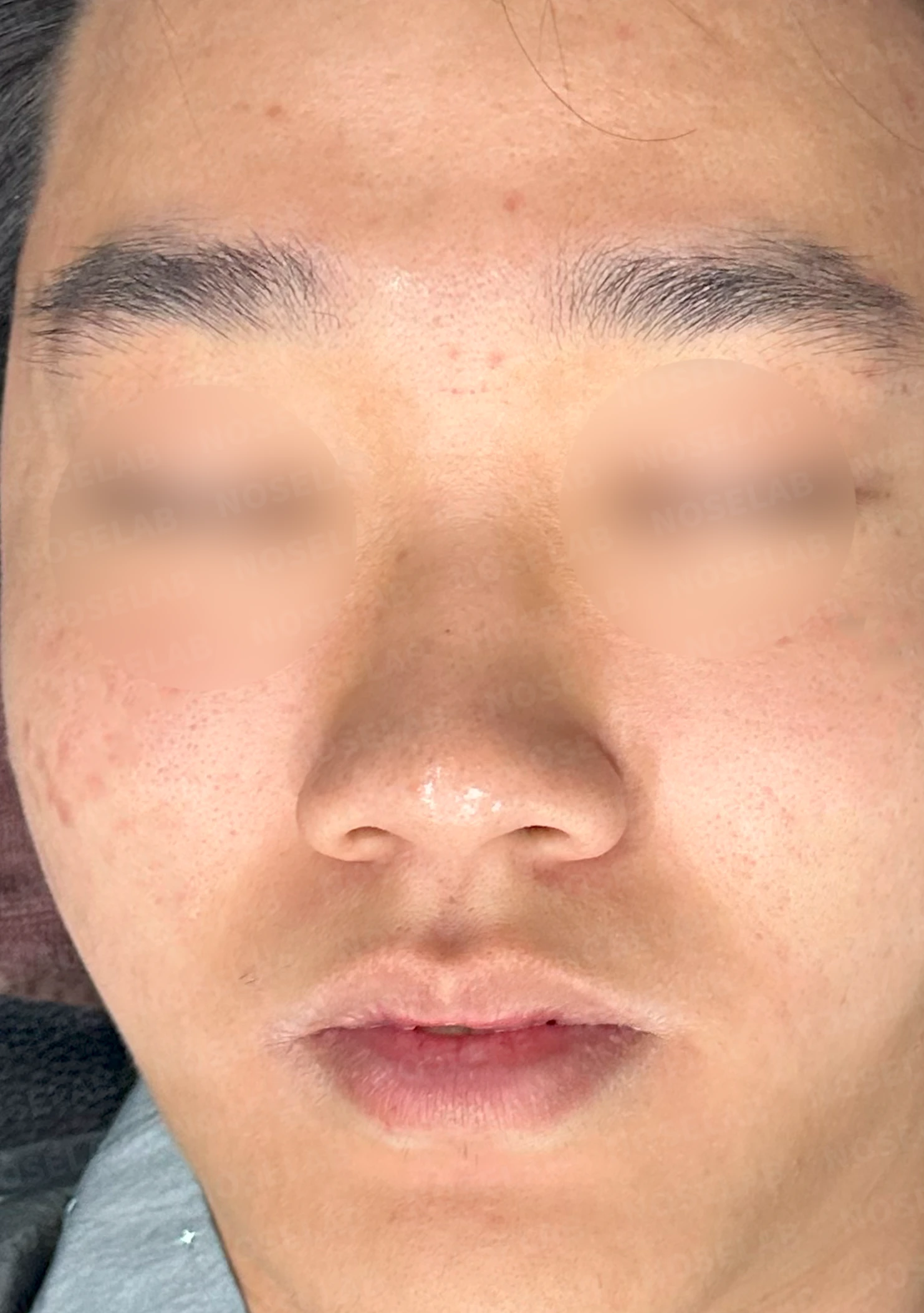 낮은 코와 코막힘을 함께 살펴보는 교정 방법 — 수술 전 / 수술 직후 0일 직후 사진은 부기가 있는 상태로 최종 결과와 다를 수 있습니다.