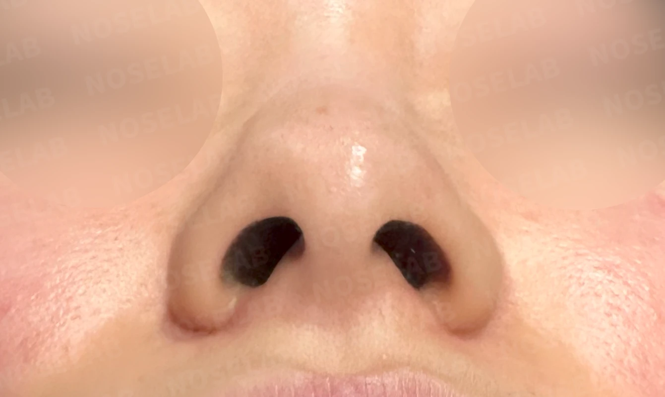 코끝이 뭉툭하게 퍼지고 코가 휘어 보이는 이유, 늑연골 재건은 어떻게 하나 — 수술 전 / 수술 직후 0일 직후 사진은 부기가 있는 상태로 최종 결과와 다를 수 있습니다.