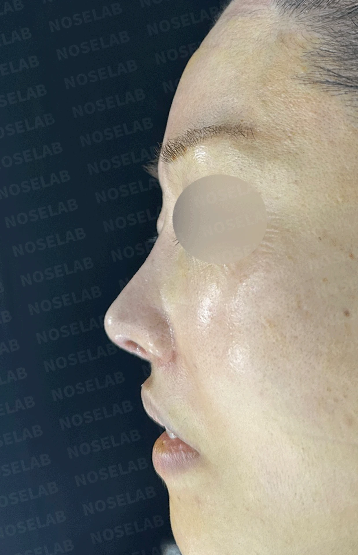 인공진피가 흡수되며 콧대가 낮아지고 퍼지는 이유 — 본문 사진 10