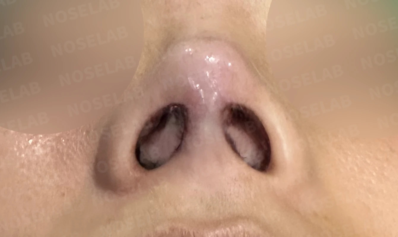 오래된 보형물 코의 코끝 지지력이 약해지는 이유와 비중격연장 재건 방법 — 수술 직후 0일 비공 사진입니다. 직후 사진은 부기가 있는 상태로 최종 결과와 다를 수 있습니다.