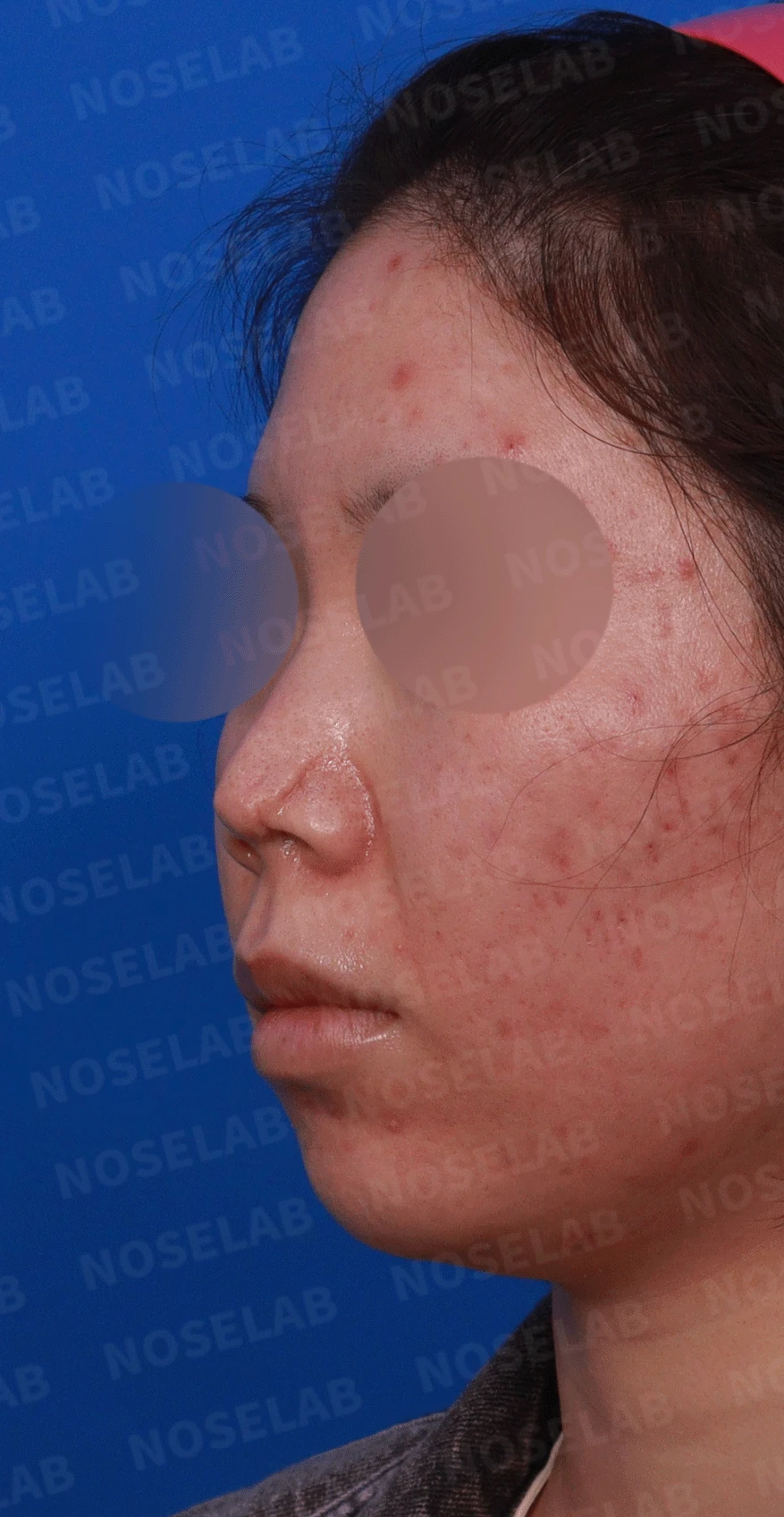 콧구멍을 막는 종괴가 생기는 이유, 제거와 재건은 어떻게 하나 — 디자인 상담 정면 , 좌측 비스듬한 측면 , 측면 사진입니다.