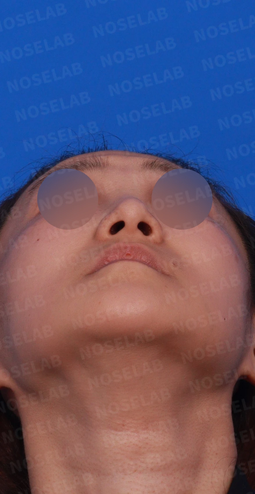 코가 한쪽으로 휘어 보이고 밤에 막히는 이유, 비중격 재건과 코막힘 개선 — 디자인 상담 우측 측면 , 비스듬한 측면 , 비공 사진입니다.
