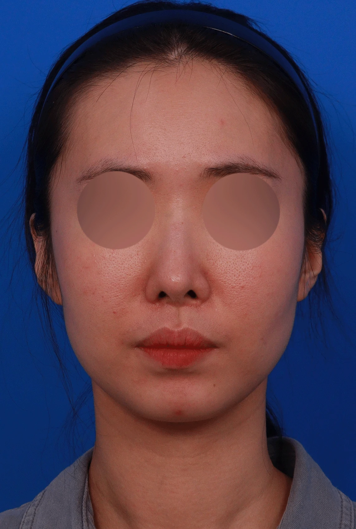 코성형 절골 후 콧등이 꺼지고 한쪽이 막히는 이유, 비밸브 재건과 복원 — 디자인 상담 정면 , 좌측 비스듬한 측면 , 측면 사진입니다.