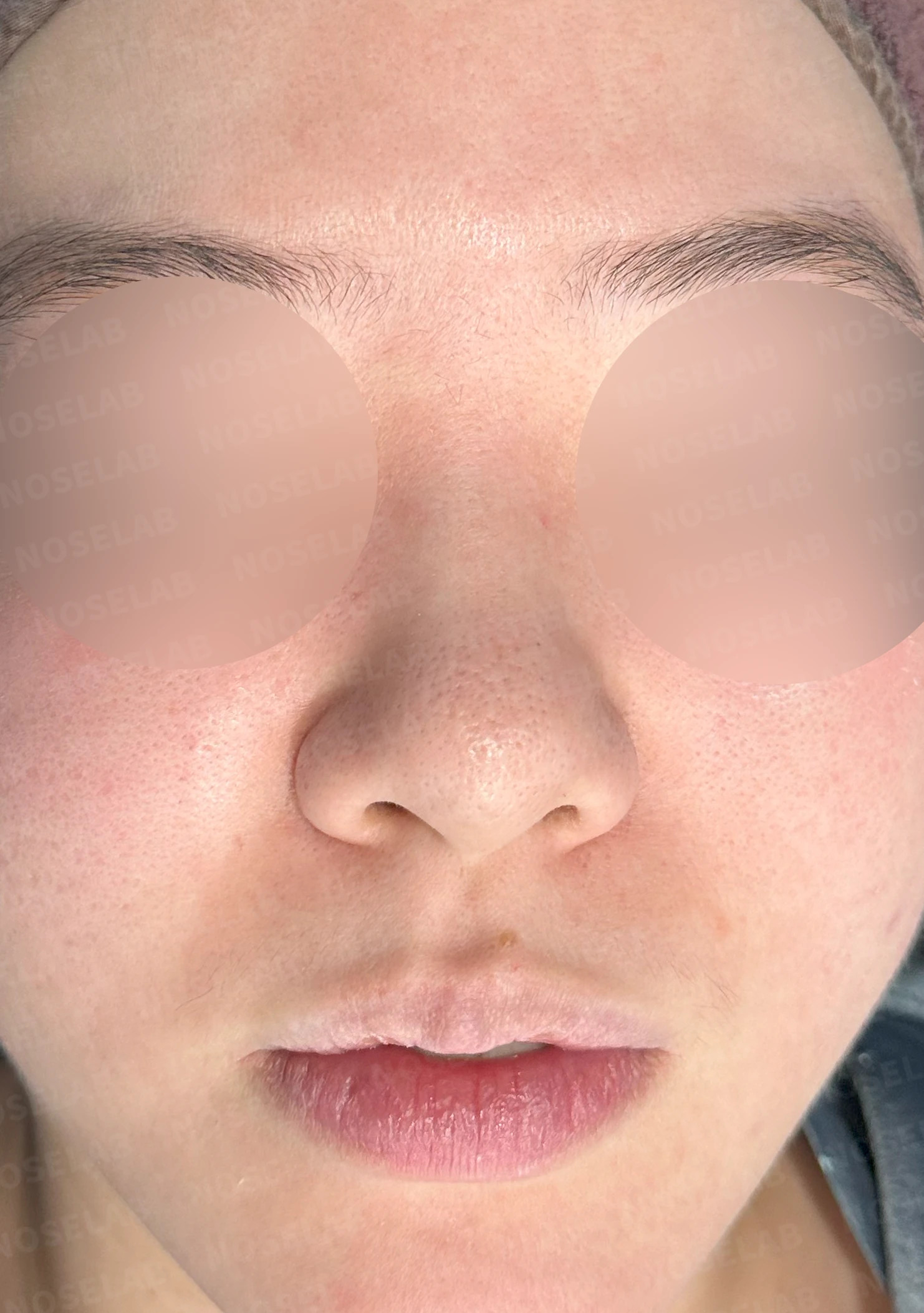 코끝이 퍼지고 입체감이 없어 보이는 이유, 복코 교정은 어떻게 하나 — 수술 전 / 수술 직후 0일 직후 사진은 부기가 있는 상태로 최종 결과와 다를 수 있습니다.