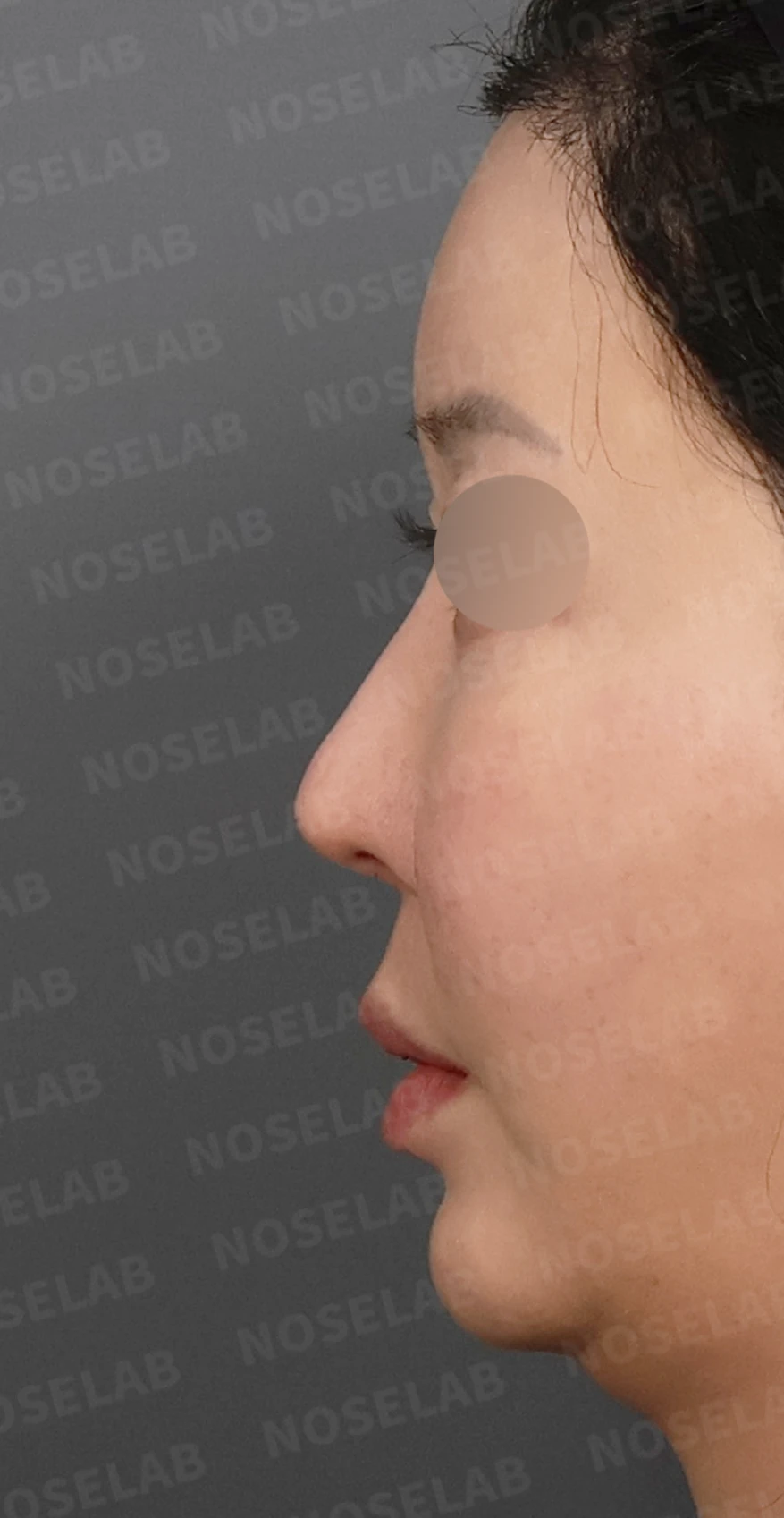 코성형 뒤 코막힘이 더 심해지는 이유, 비중격 재건과 절골 복원은 어떻게 하나 — 디자인 상담 정면, 좌측 측면, 비스듬한 측면 사진입니다.