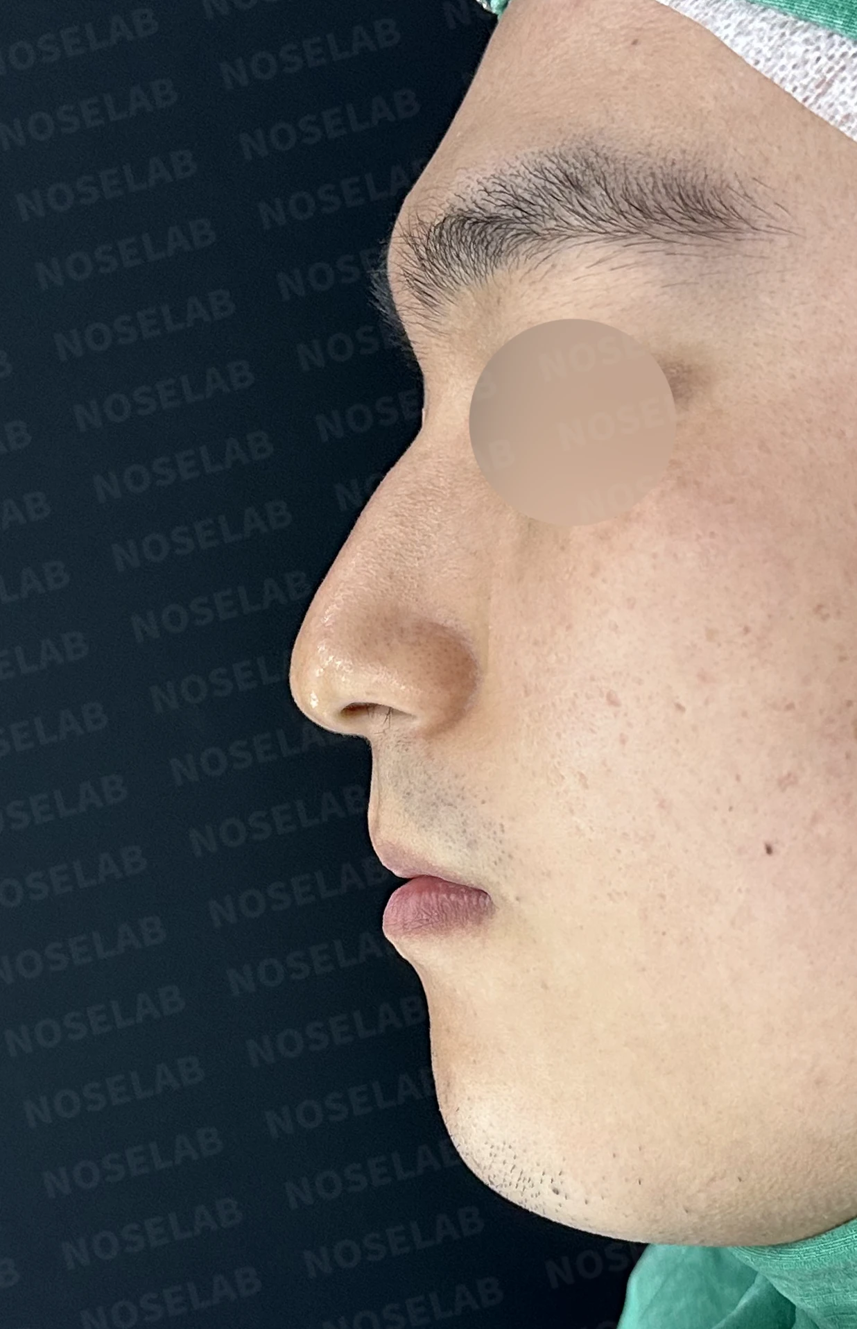 비중격이 휘면 코막힘과 휜 코가 함께 생기는 이유, 재건은 어떻게 하나 — 수술 전 / 수술 직후 0일 직후 사진은 부기가 있는 상태로 최종 결과와 다를 수 있습니다.