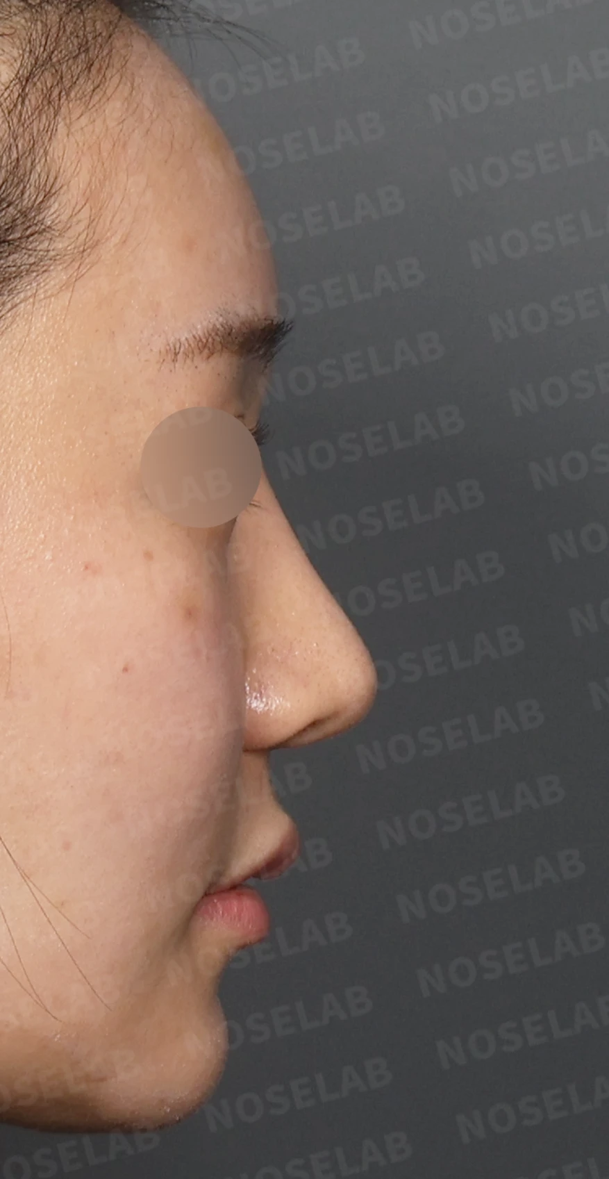 뭉툭하고 처진 긴코, 비개방 코재수술로 여성스러운 직반라인 완성 — 디자인 상담 우측 측면, 비스듬한 측면, 비공 사진입니다.