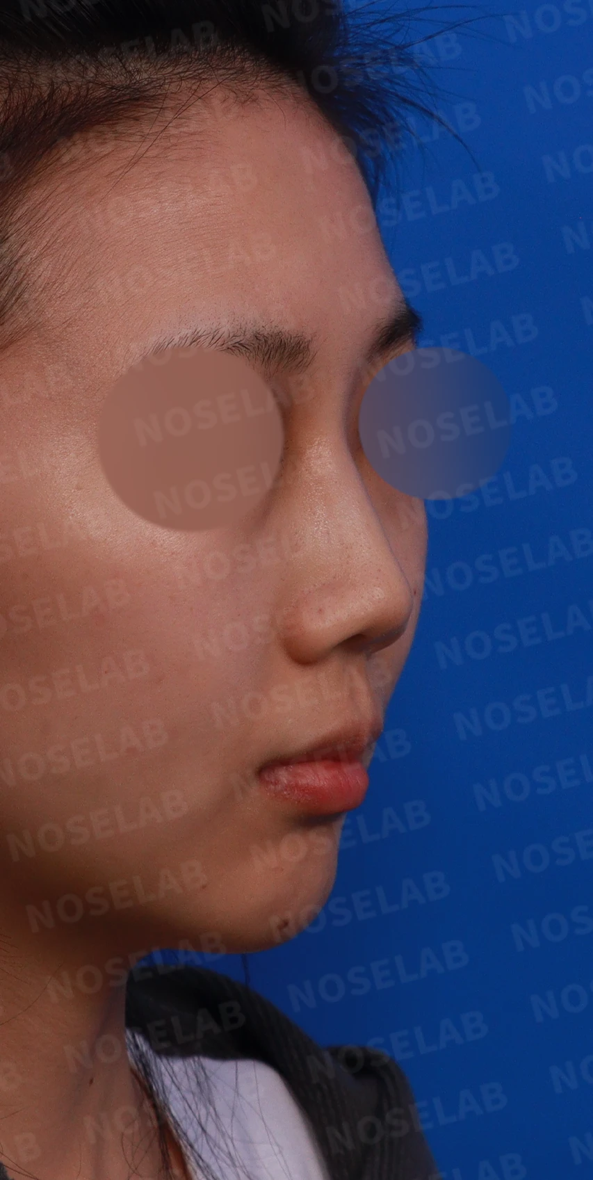 작은 코와 비공 비대칭을 함께 살펴보는 교정 방법 — 본문 사진 5