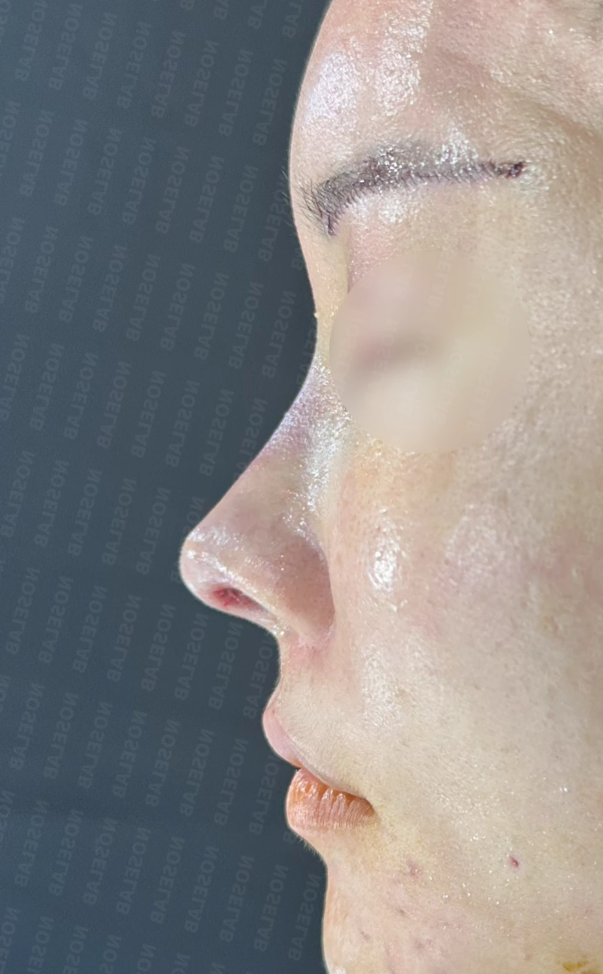 비주 내리기와 비순각 교정을 함께 계획하는 방법 — 수술 직후 0일 정면, 측면, 비슷한 측면 직후 사진은 부기가 있는 상태로 최종 결과와 다를 수 있습니다.