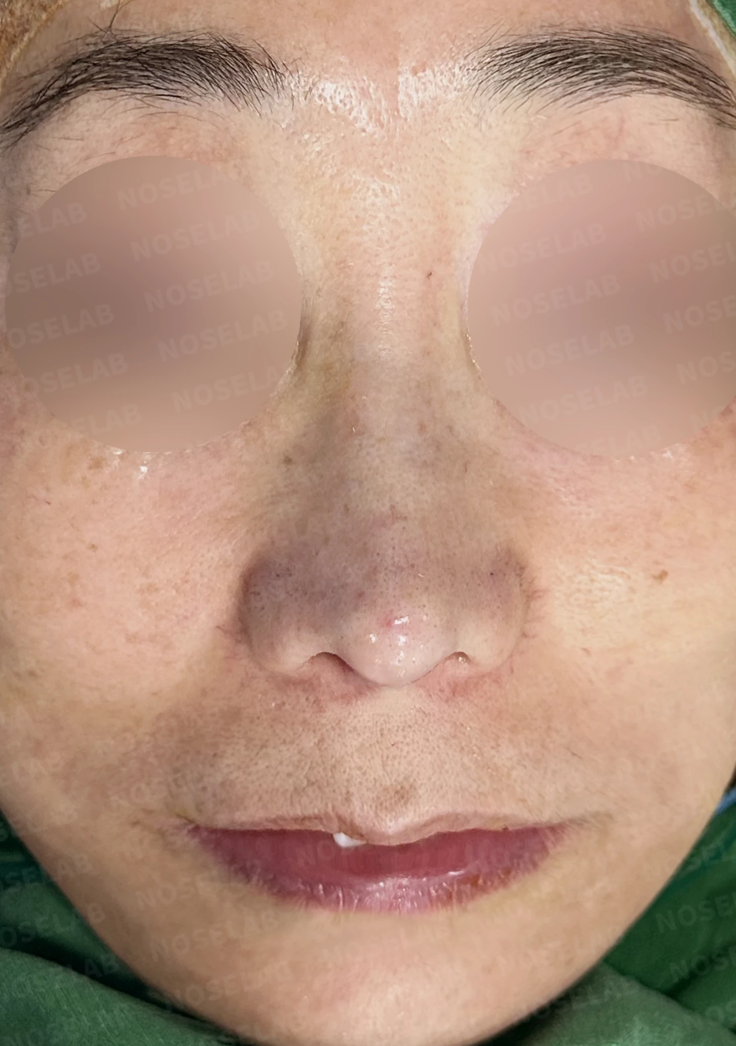 정면에서 콧구멍이 한쪽만 더 보이는 이유와 코끝 재건 방법 — 수술 직후 0일 정면, 비스듬한 측면, 측면 사진입니다. 직후 사진은 부기가 있는 상태로 최종 결과와 다를 수 있습니다.